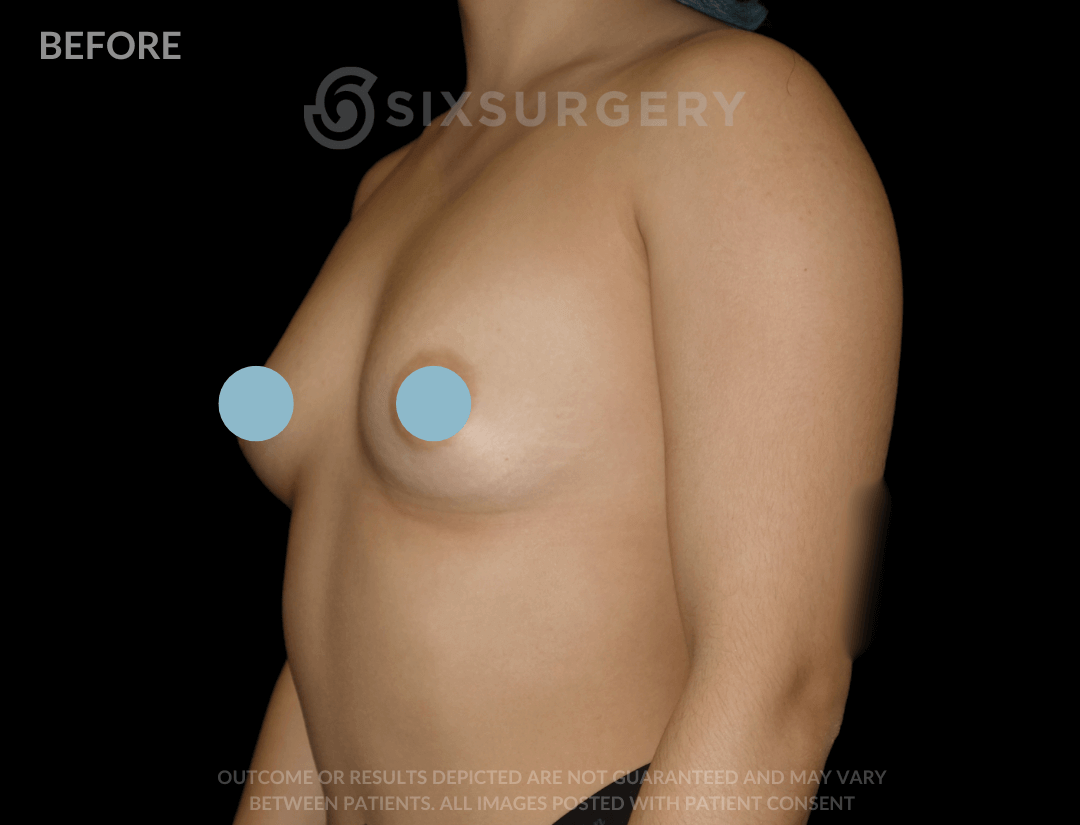 Breast Augmentation Silicone 450cc High Profile Breast fold White Female