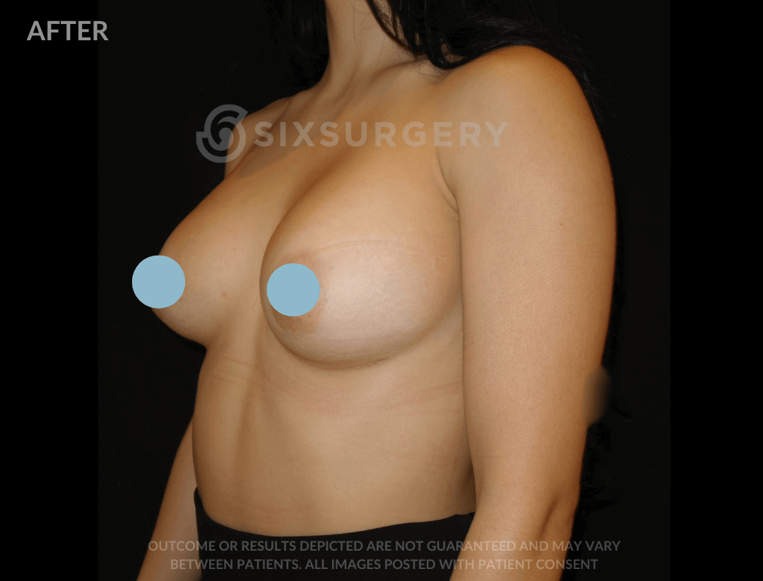 Breast Augmentation Silicone 450cc High Profile Breast fold White Female