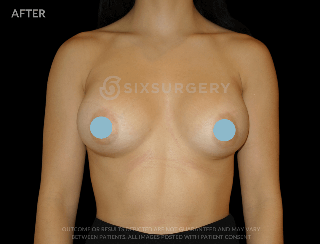 Breast Augmentation Silicone 450cc High Profile Breast fold White Female