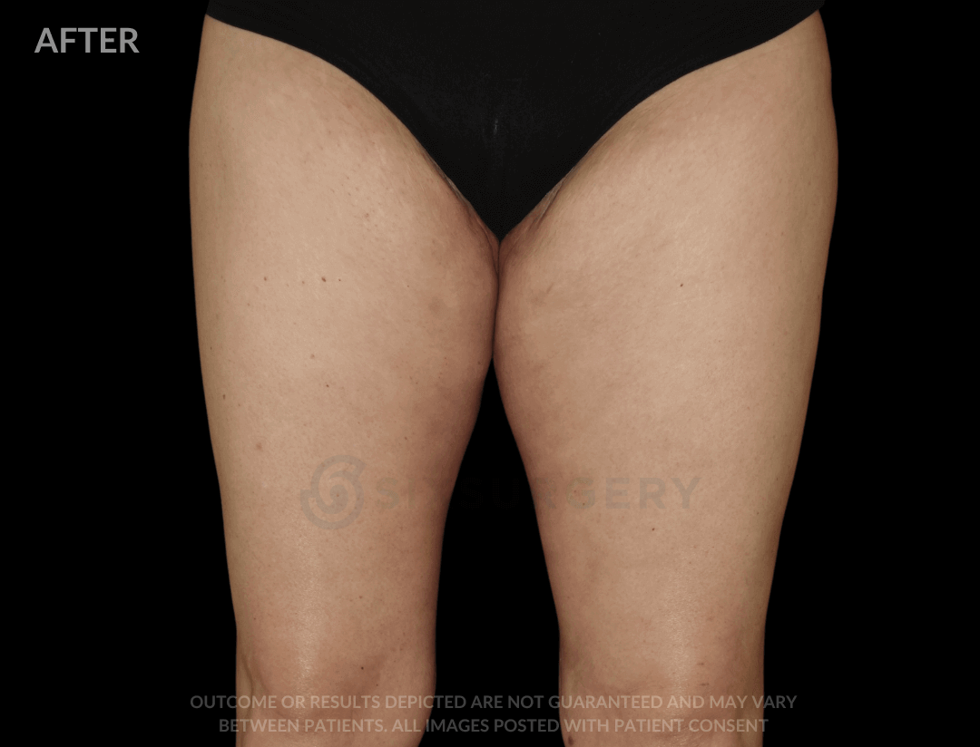 Thigh Lift 30 Year Old