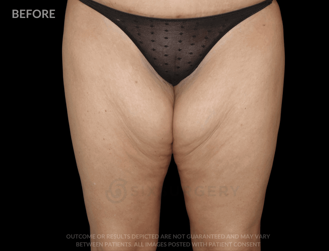 Thigh Lift 30 Year Old