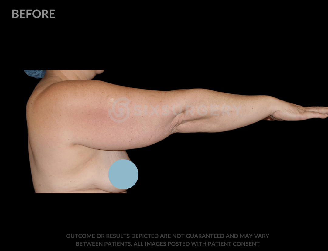 Arm Lift with Body Lift 41 Year Old BMI 22.9 
