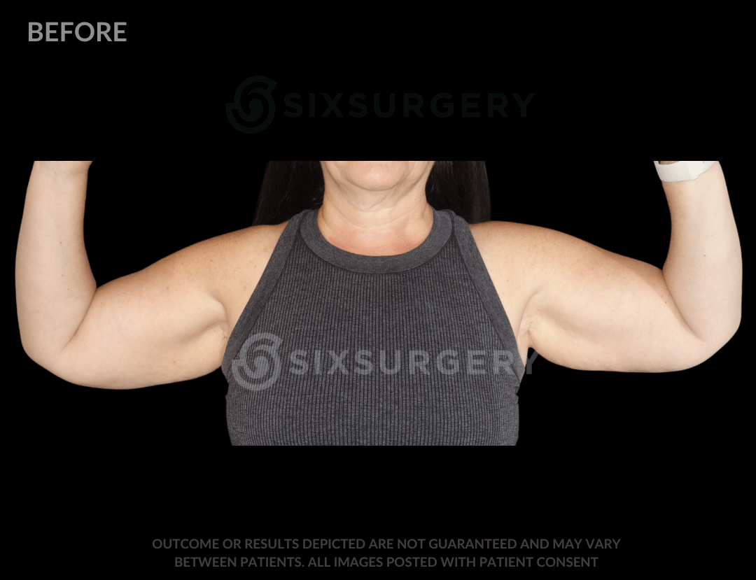Arm Lift with Body Lift 41 Year Old BMI 22.9 