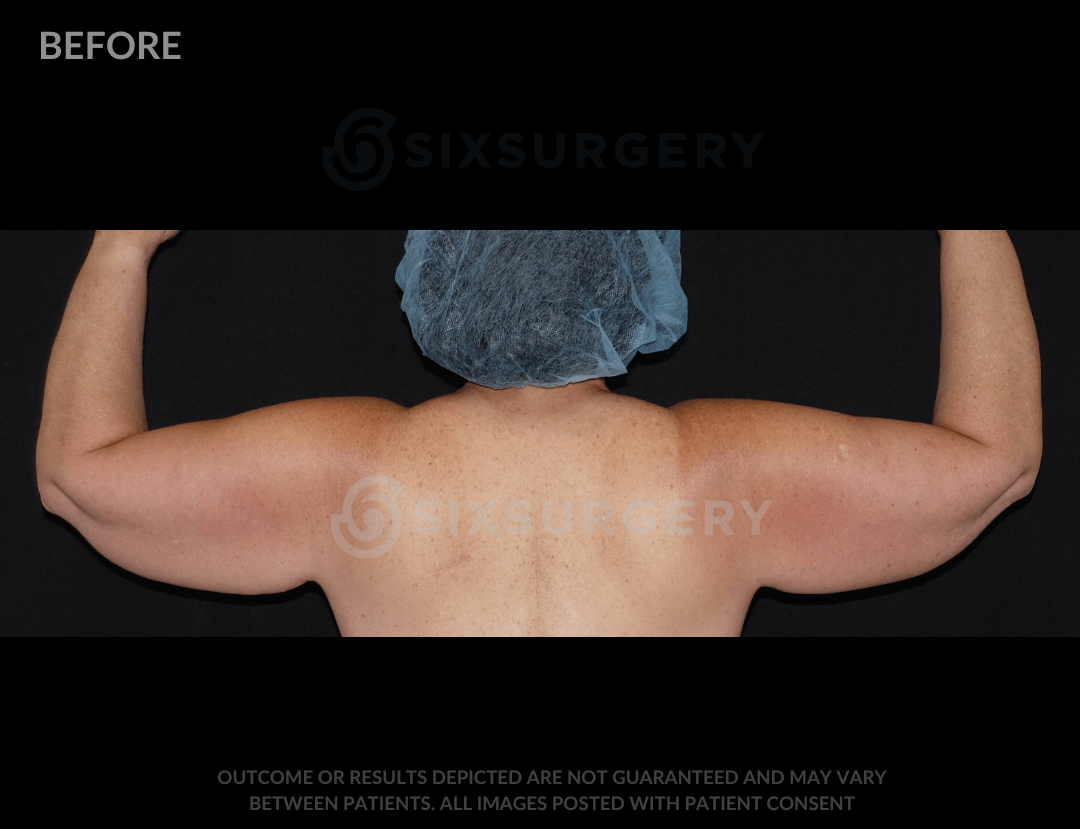 Arm Lift with Body Lift 41 Year Old BMI 22.9 