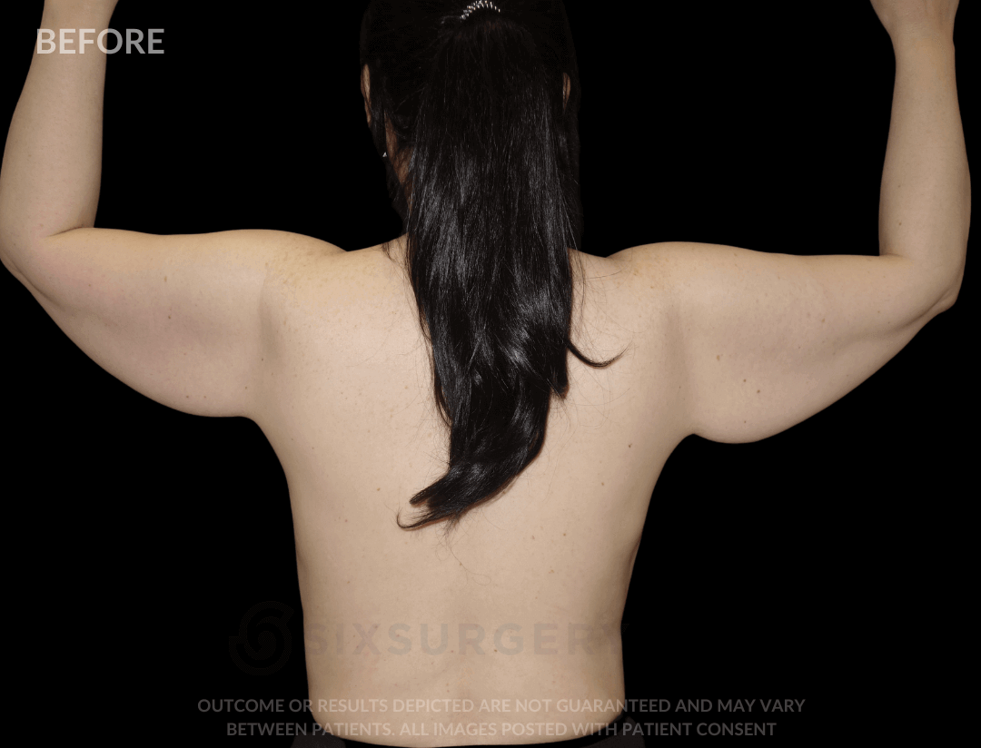 Arm Lift with Body Lift 41 Year Old BMI 22.9 