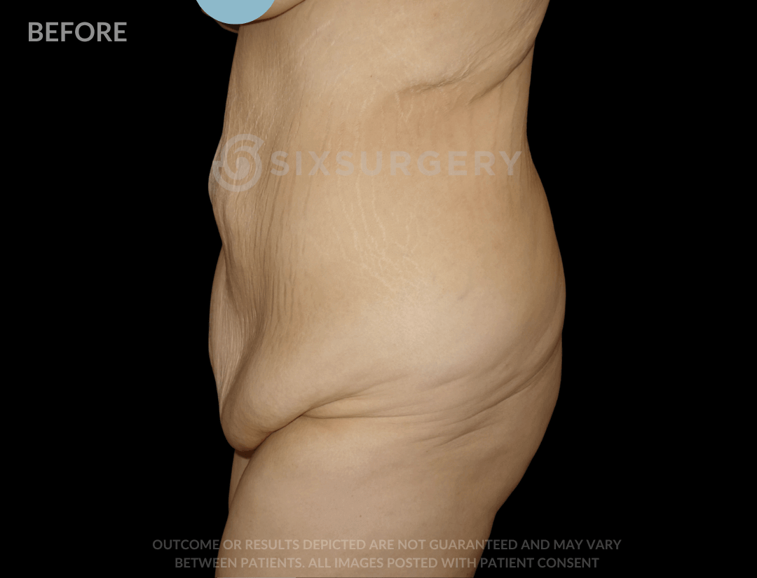 Body Lift with Tummy Tuck 38 Year Old
