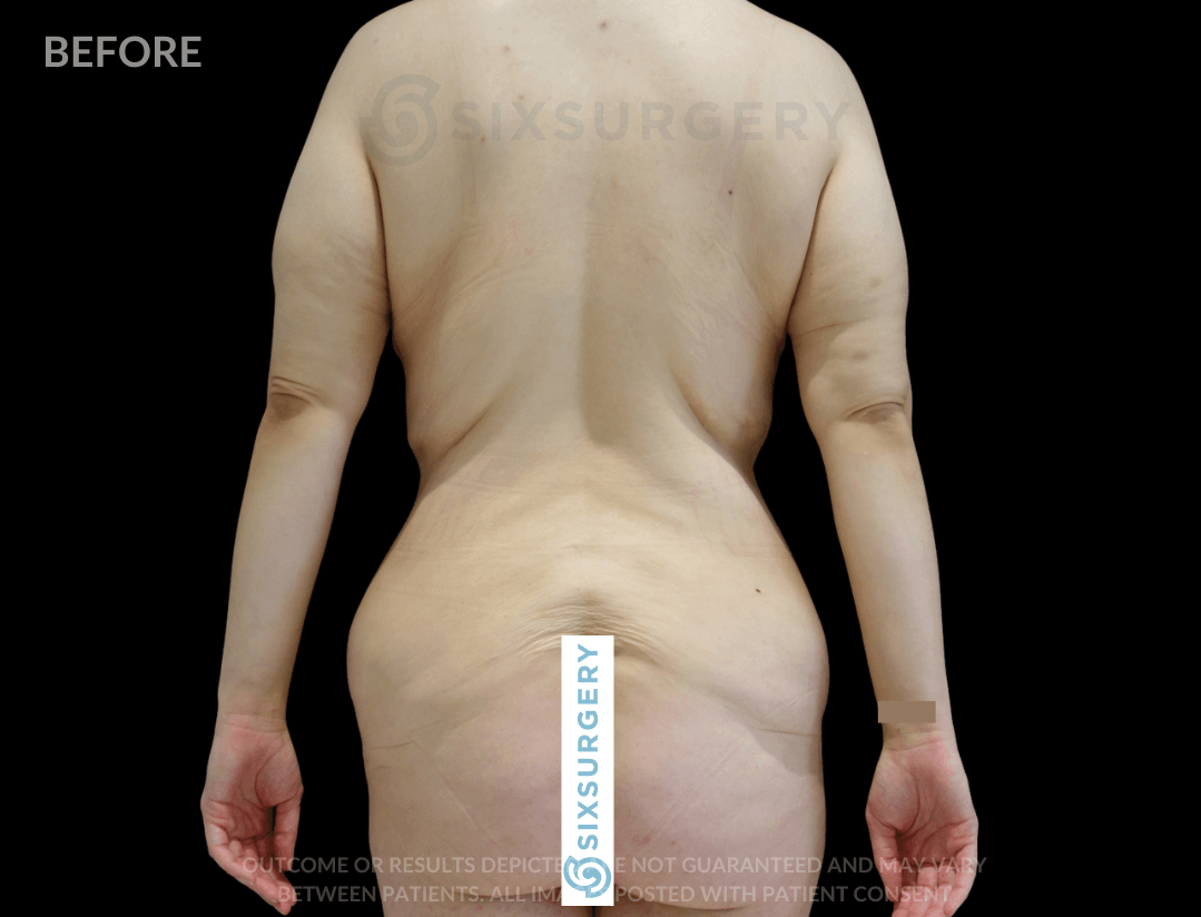 Body Lift with Tummy Tuck 38 Year Old