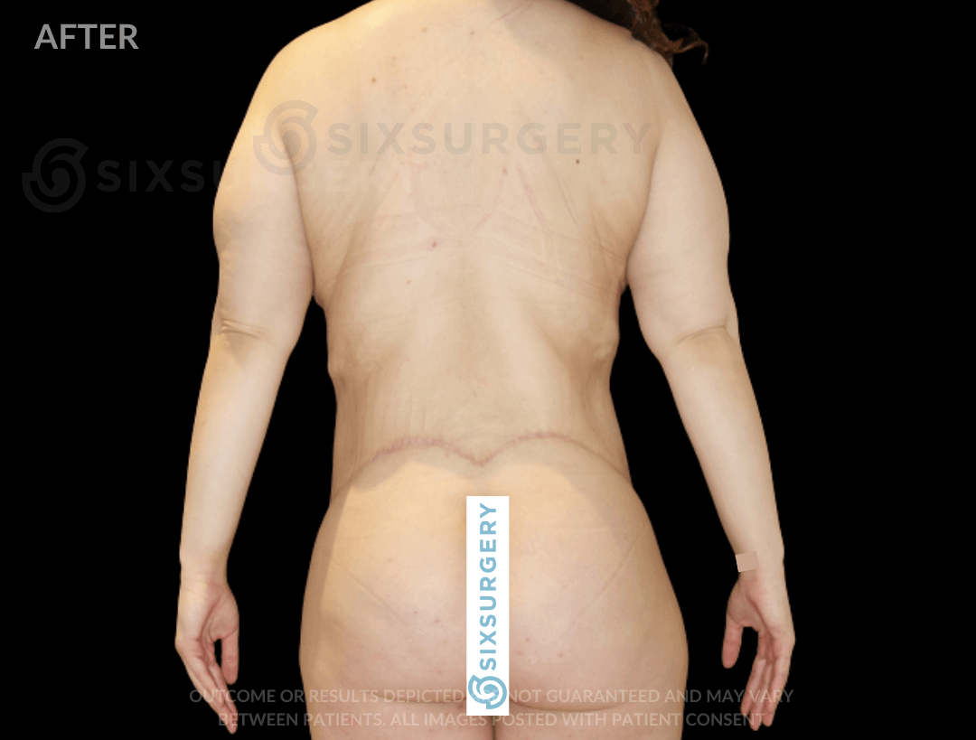 Body Lift with Tummy Tuck 38 Year Old BMI 21