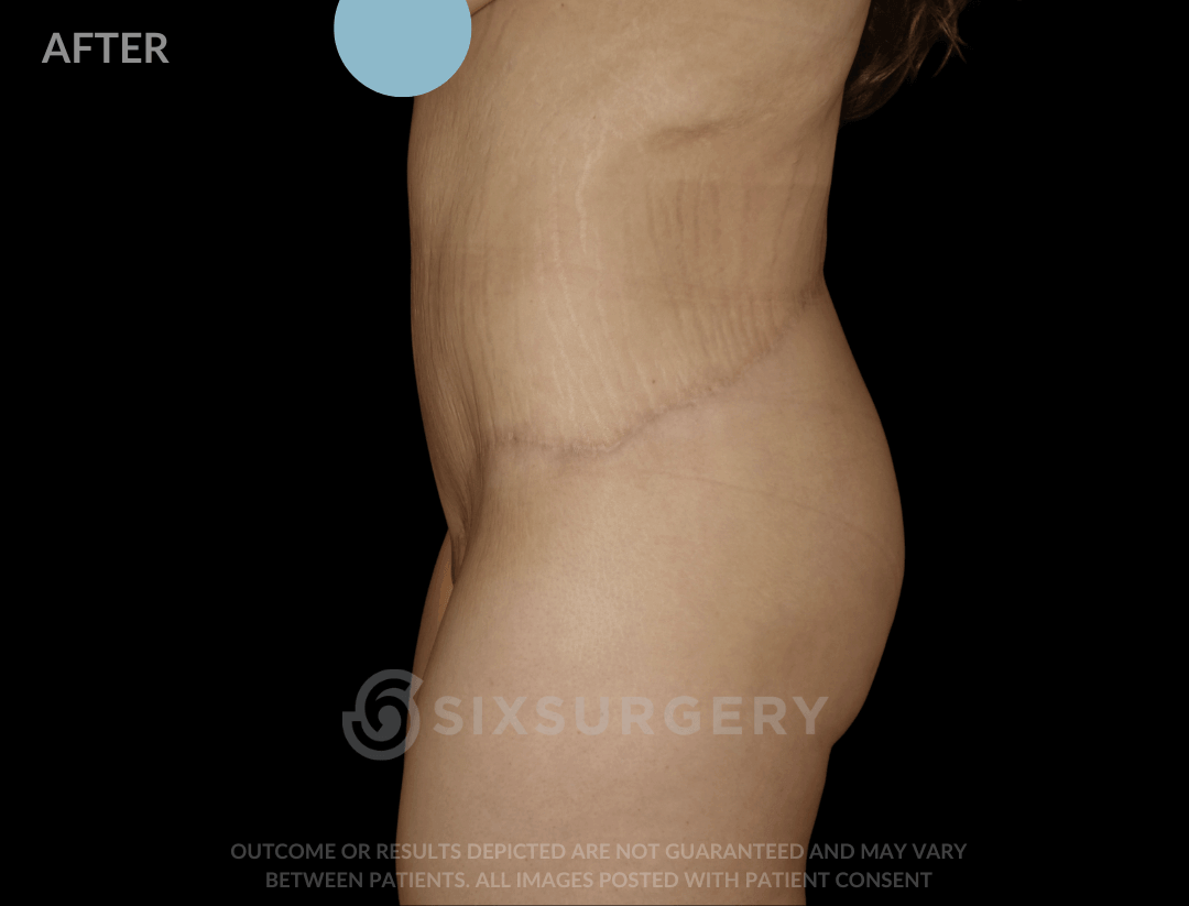 Body Lift with Tummy Tuck 38 Year Old BMI 21