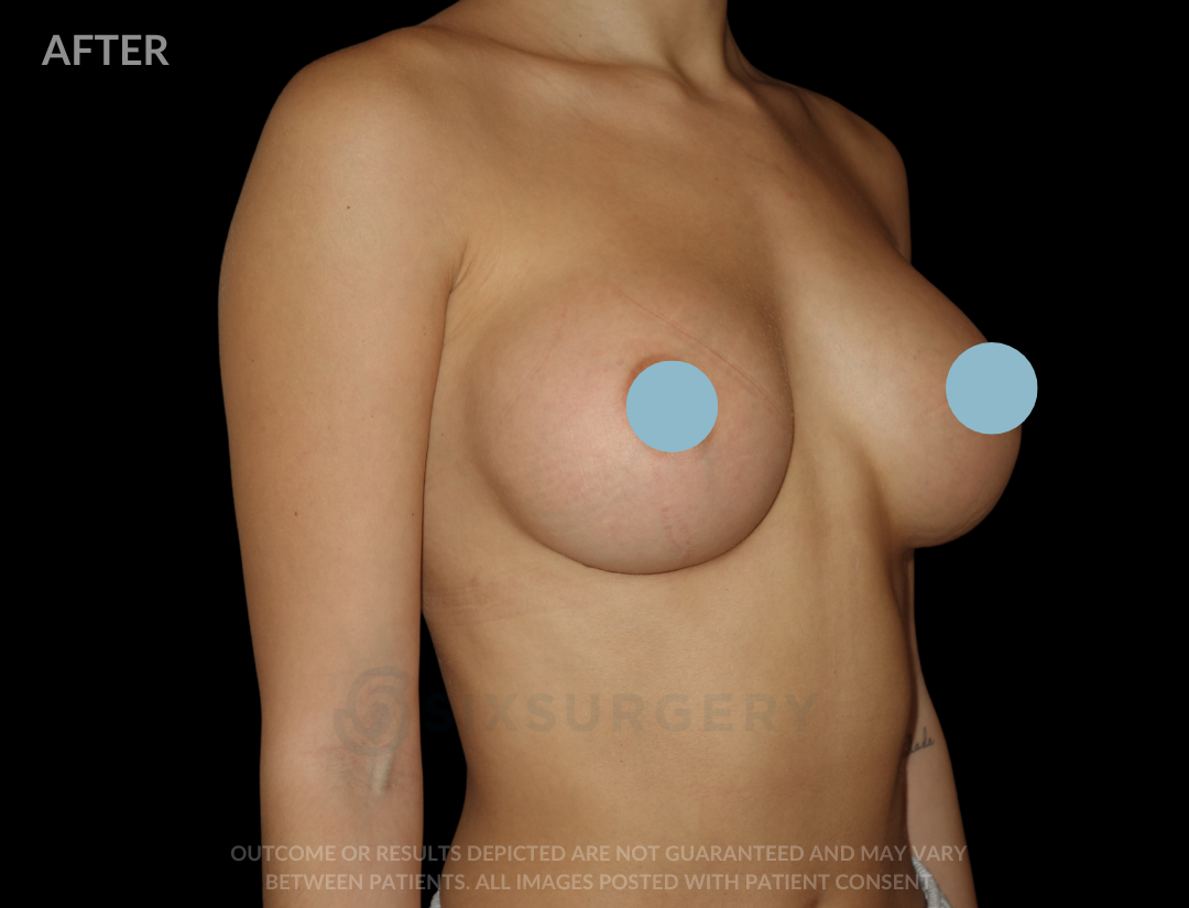 Breast Augmentation Silicone 450cc High Profile Breast fold White Female