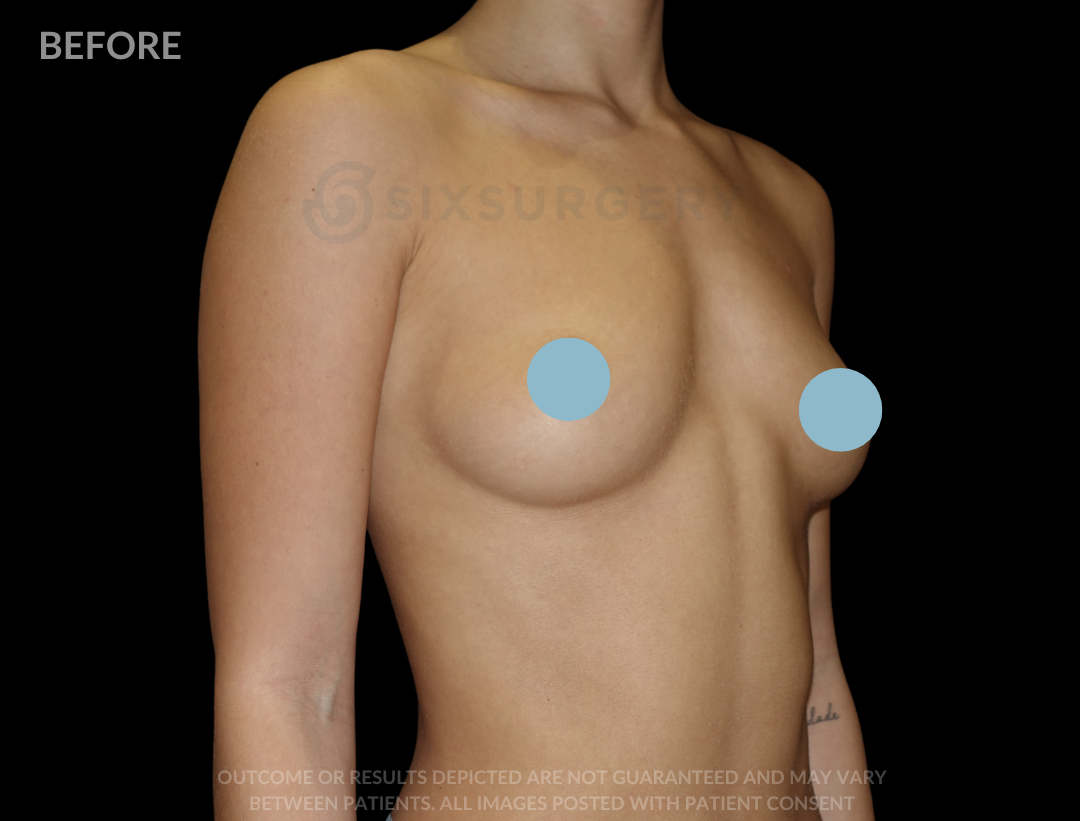 Breast Augmentation Silicone 450cc High Profile Breast fold White Female