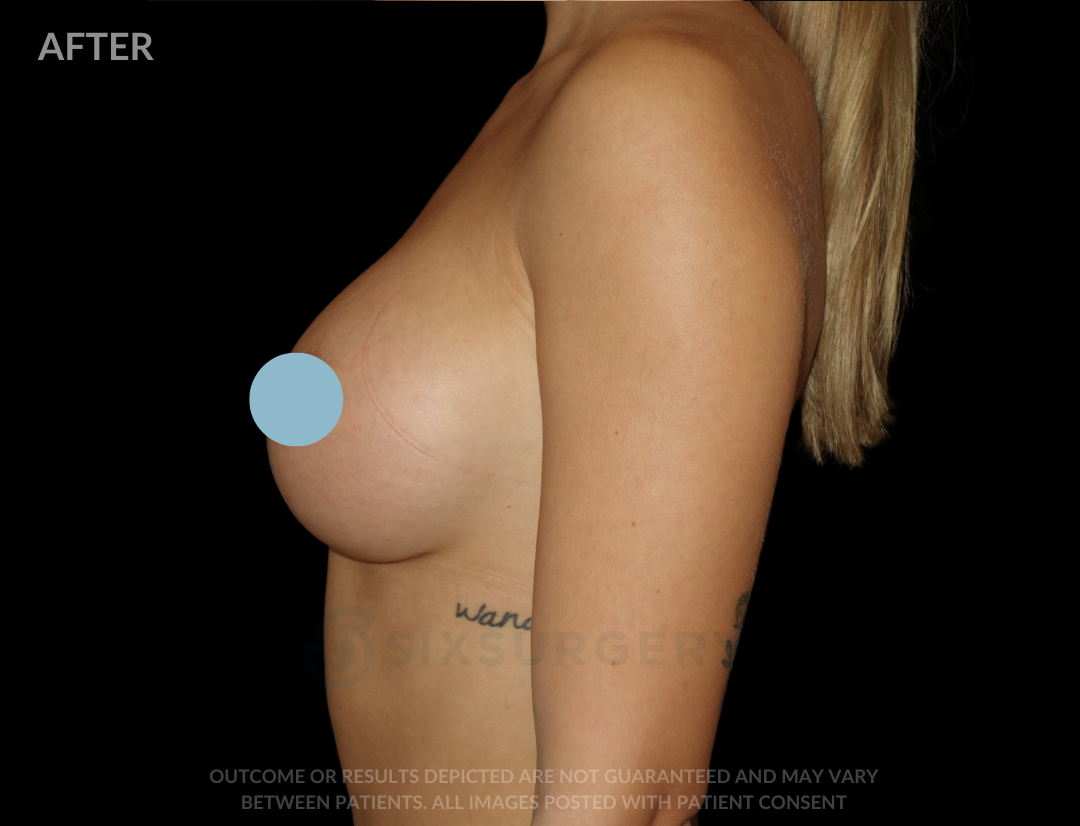 Breast Augmentation Silicone 450cc High Profile Breast fold White Female