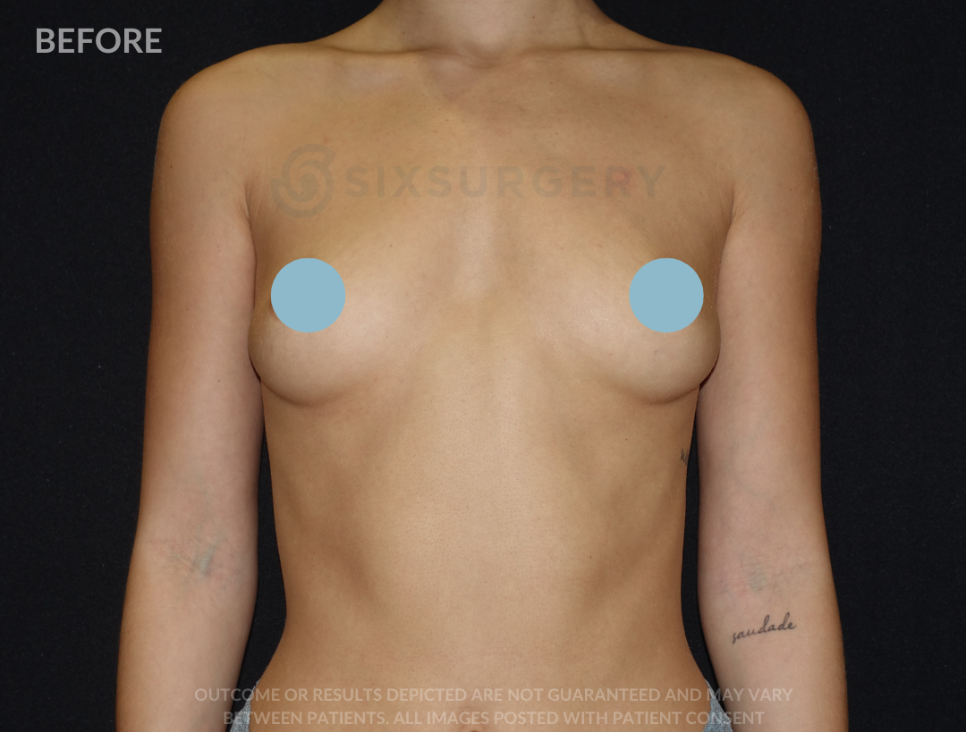 Breast Augmentation Silicone 450cc High Profile Breast fold White Female