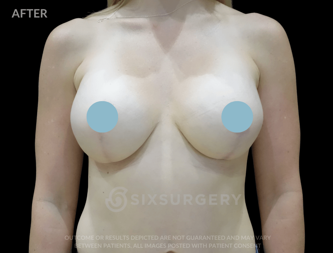 Breast Lift with Breast Augmentation 365cc 30-39 year old
