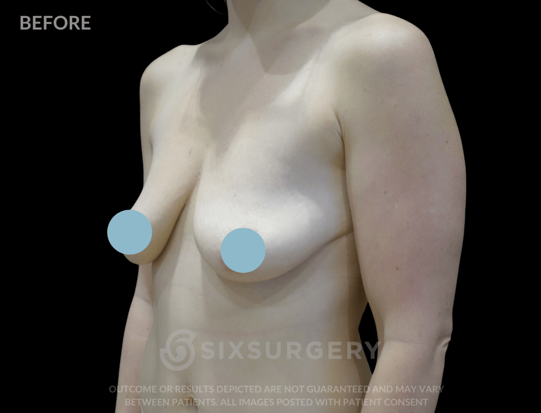 Breast Lift with Breast Augmentation 365cc 30-39 year old