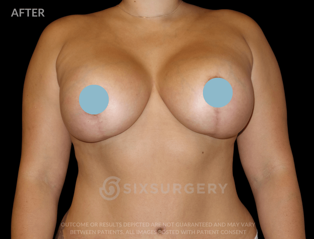 Breast Lift with Breast Augmentation 560cc 30-39 year old