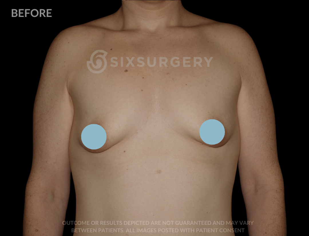 Breast Lift with Breast Augmentation 650cc 30-39 year old
