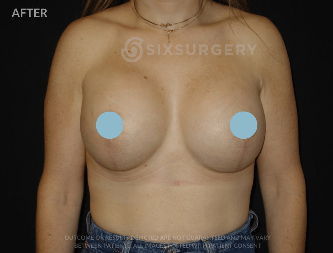 Breast Lift with Breast Augmentation 650cc 30-39 year old