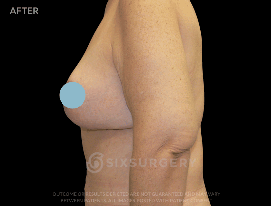 Breast Lift with Breast Augmentation 350cc 40-49 year old