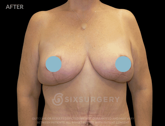 Breast Lift with Breast Augmentation 320cc 40-49 year old