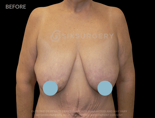 Breast Lift with Breast Augmentation 320cc 40-49 year old