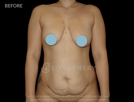Mommy Makeover with Breast Reduction 55 year old