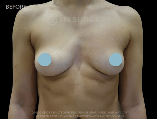 Breast Augmentation Saline 410cc High Profile Armpit White Female