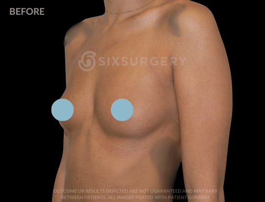 Breast Augmentation Saline 550cc High Profile Armpit Hispanic Female
