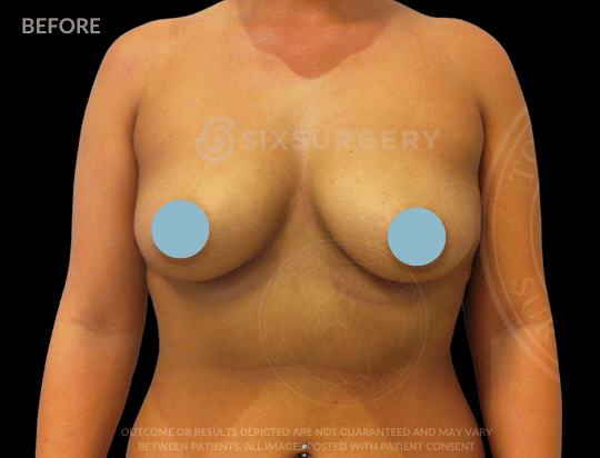 Breast Augmentation Saline 450cc High Profile Breast fold Asian Female