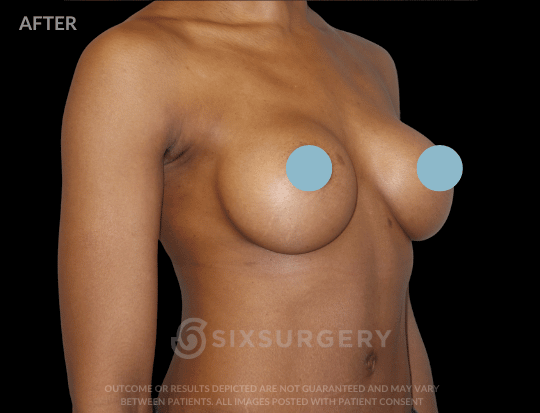 Breast Augmentation Saline 415cc High Profile Armpit Black Female