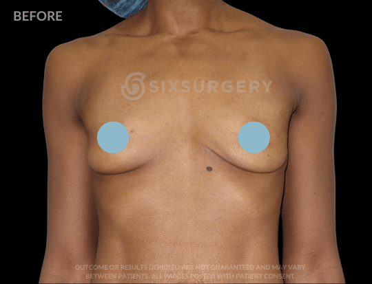 Breast Augmentation Saline 415cc High Profile Armpit Black Female