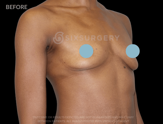 Breast Augmentation Saline 415cc High Profile Armpit Black Female