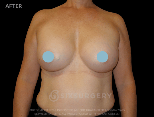 Breast Augmentation Saline 400cc Moderate Profile Breast fold White Female