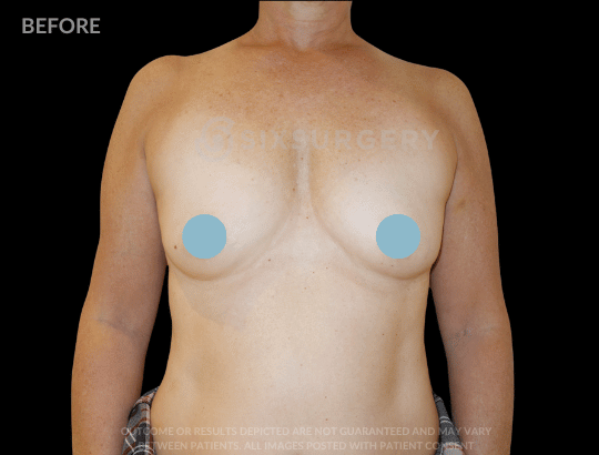 Breast Augmentation Saline 400cc Moderate Profile Breast fold White Female