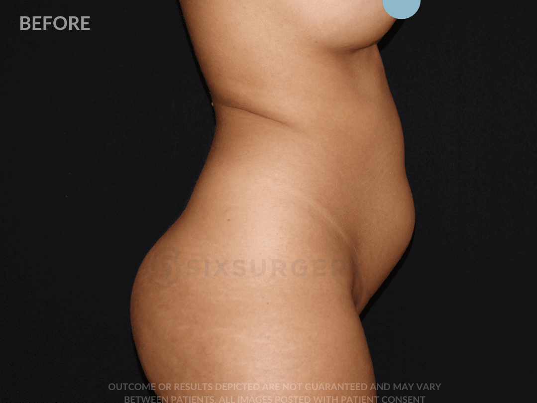 Liposuction 2500cc 52 year old