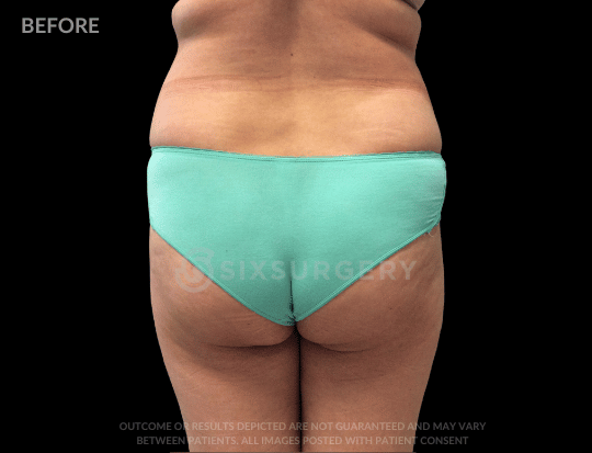 Liposuction 2500cc 52 year old