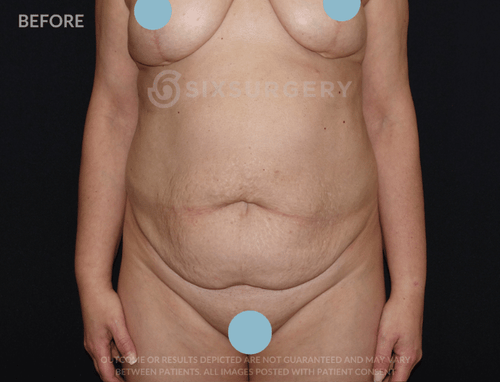 Tummy Tuck with Breast Reduction 5200cc Muscle Repair 57 year old