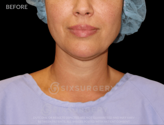 Neck Liposuction 45 year old