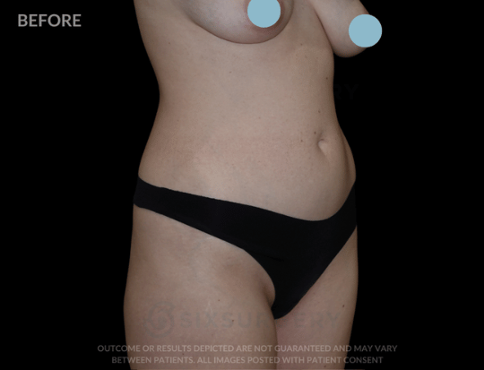 Liposuction 2500cc 52 year old