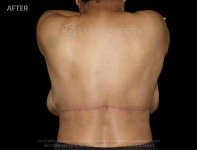Body Lift with Tummy Tuck 38 Year Old BMI 21