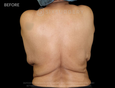 Body Lift with Tummy Tuck 38 Year Old