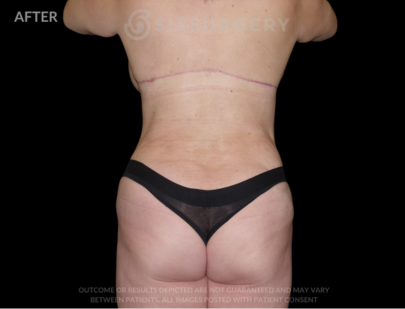 Body Lift with Tummy Tuck 38 Year Old BMI 21