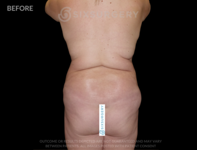 Body Lift with Tummy Tuck 38 Year Old