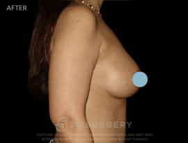 Breast Augmentation Silicone 450cc High Profile Breast fold White Female