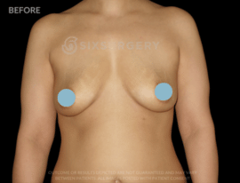 Breast Augmentation Silicone 450cc High Profile Breast fold White Female