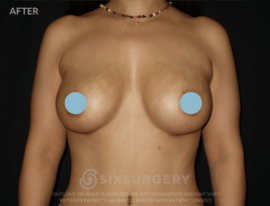 Breast Augmentation Silicone 450cc High Profile Breast fold White Female