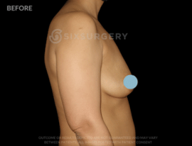Breast Augmentation Silicone 450cc High Profile Breast fold White Female