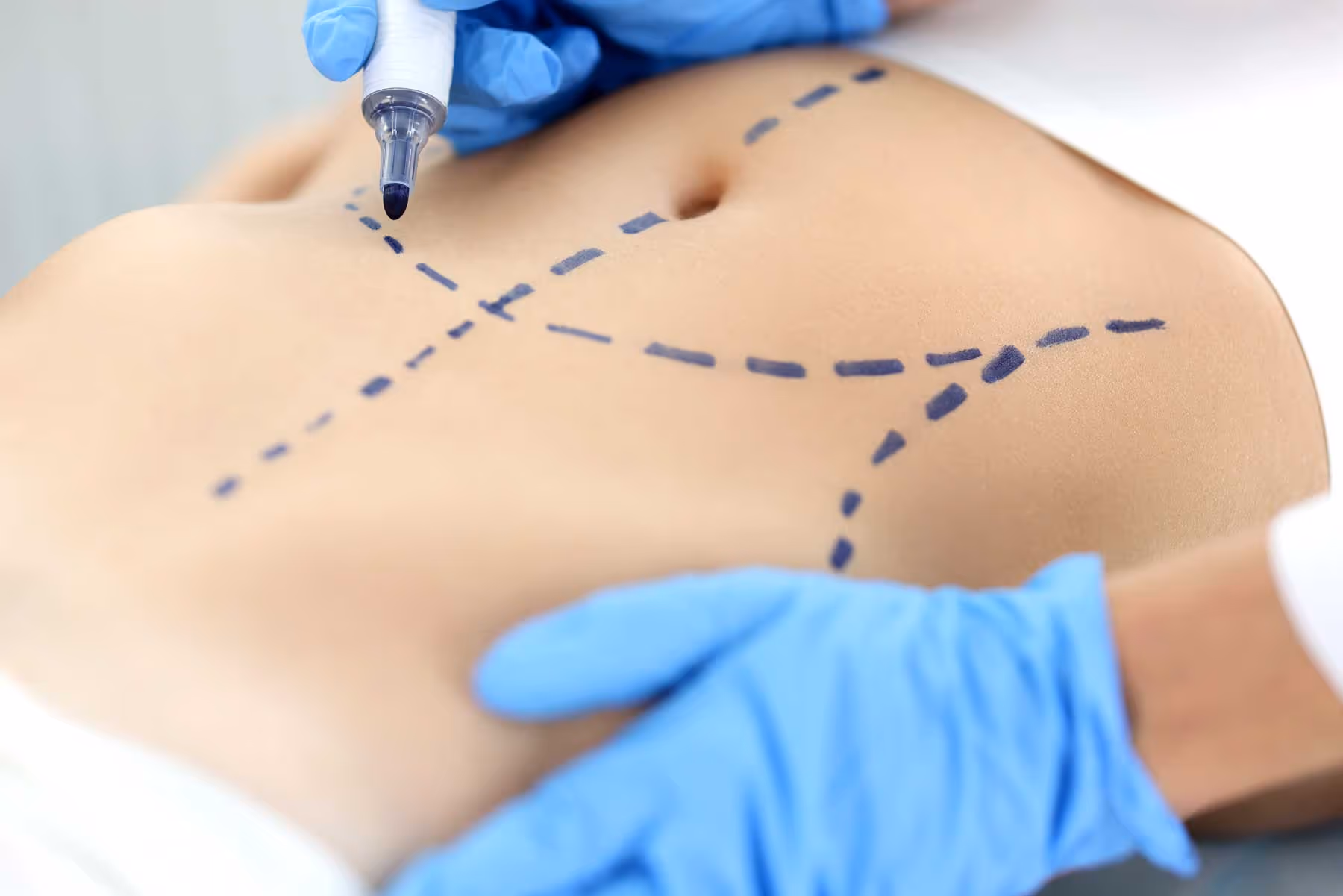 Was kostet eine Liposuktion?