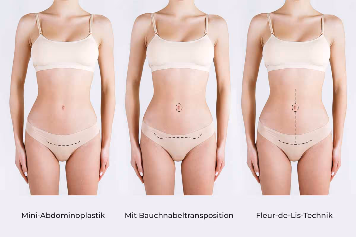 Bauchdeckenstraffung Schnittführung