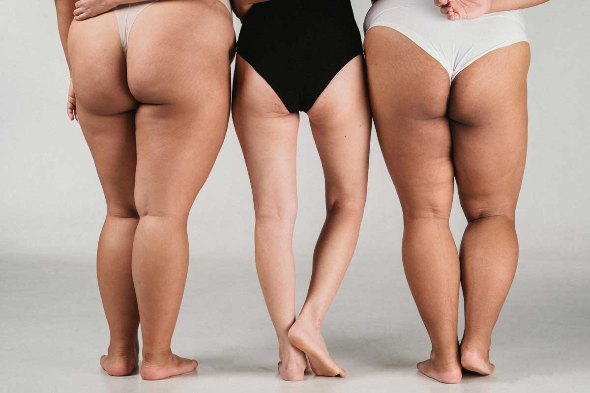 Frau mit Lipödem an den Beinen – Darstellung der Fettverteilung und Behandlungsmöglichkeiten wie Liposuktion und Hautstraffung